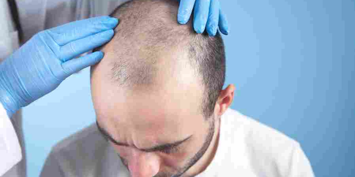 Top Hair Transplant in Dubai: Expert Solutions for Hair Loss