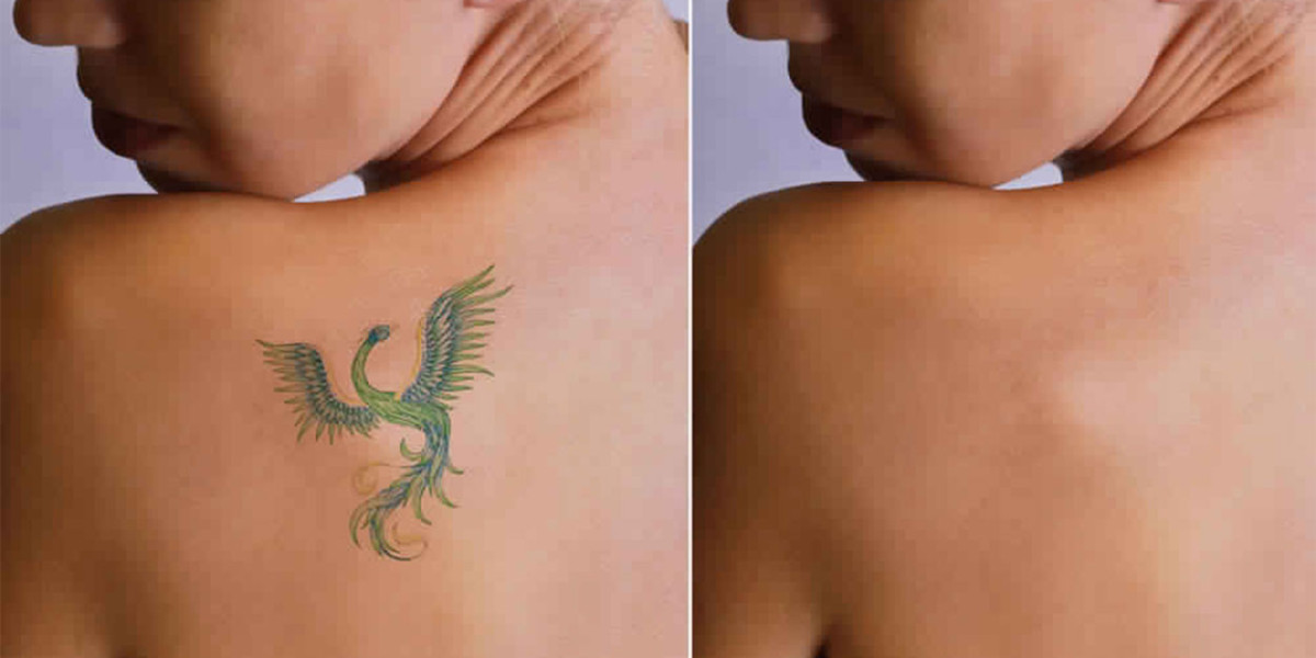 Unveiling the Art of Tattoo Removal in Indirapuram — Dr. Anima Mishra