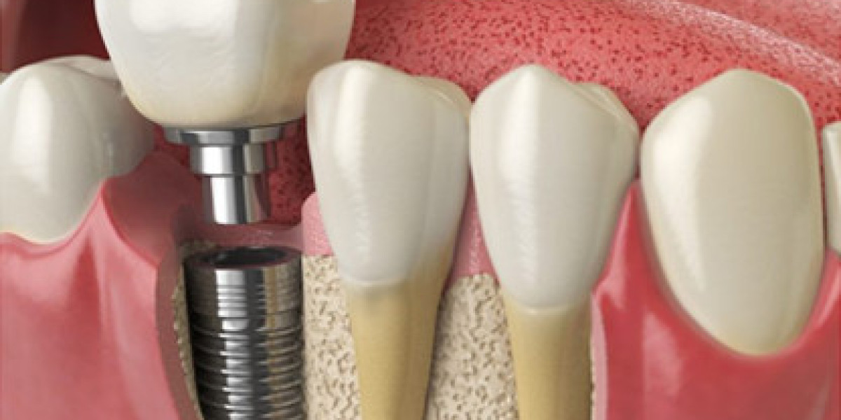 Zirconia Implants in Immediate Extraction Sites: Clinical Challenges and Successes