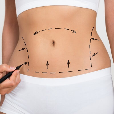 Liposuction in Dubai & Abu Dhabi | Best Liposuction Surgeons | AED 7,399+