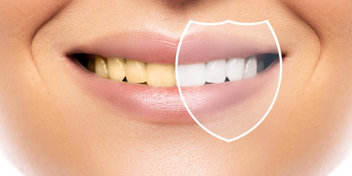 Crafting Your Perfect Smile: Choosing the Right Number of Zoom Teeth Whitening Sessions