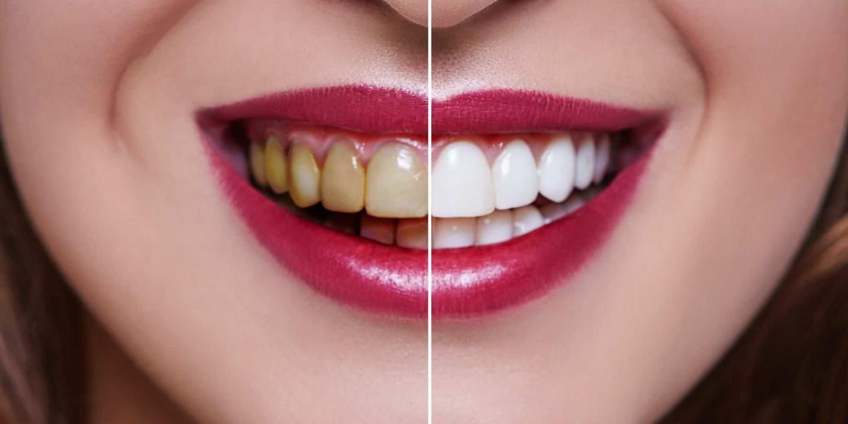 Cultural Perspectives on Teeth Whitening: Beauty Standards in Dubai