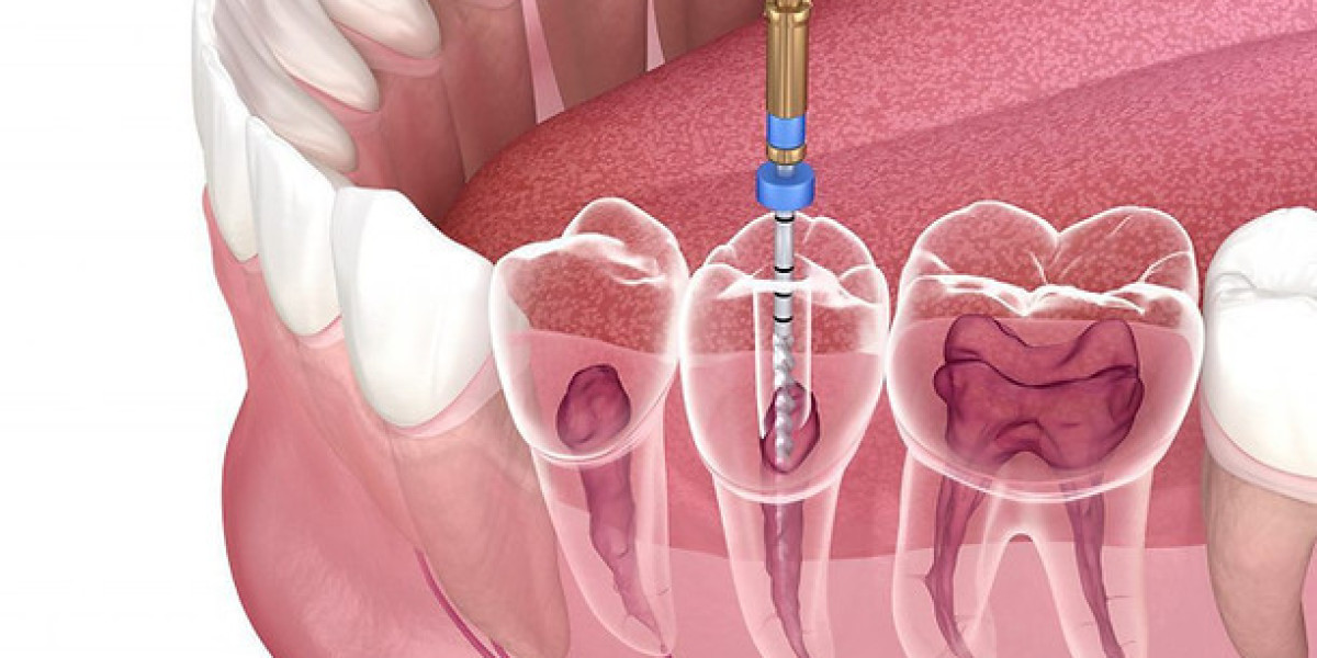 The Importance of Root Canal Treatment for Dental Health in Dubai