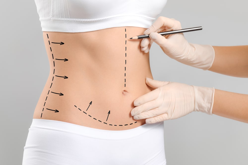 The Incredible Impact of TummyTuck