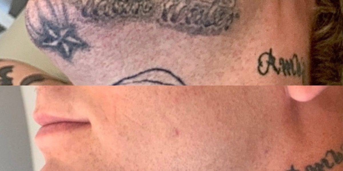 Celebrities Share Their Laser Tattoo Removal Journeys in 2024