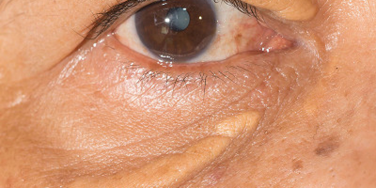 How do you stop Eyelid Xanthelasma Removal in Dubai from growing?