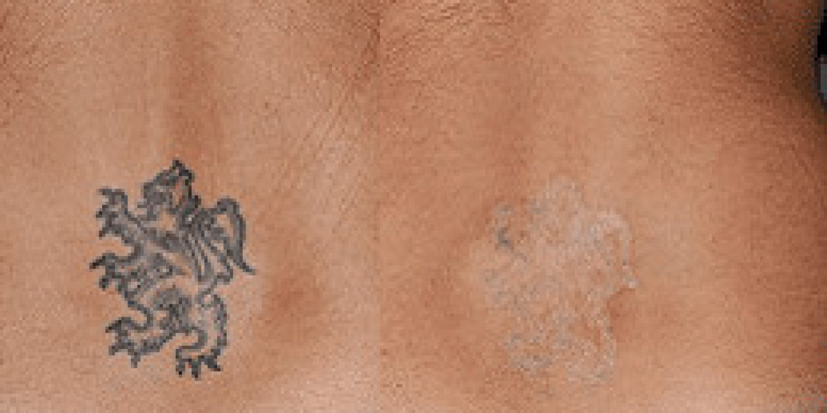 Achieving Clear Skin with Laser Tattoo Removal