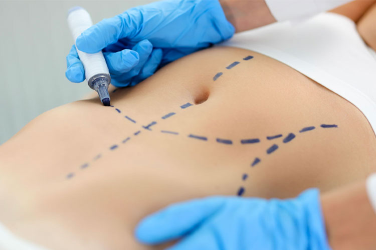 Latest Innovative Tummy Tuck Procedure - BlogTraffic: Your Gateway to Online Visibility