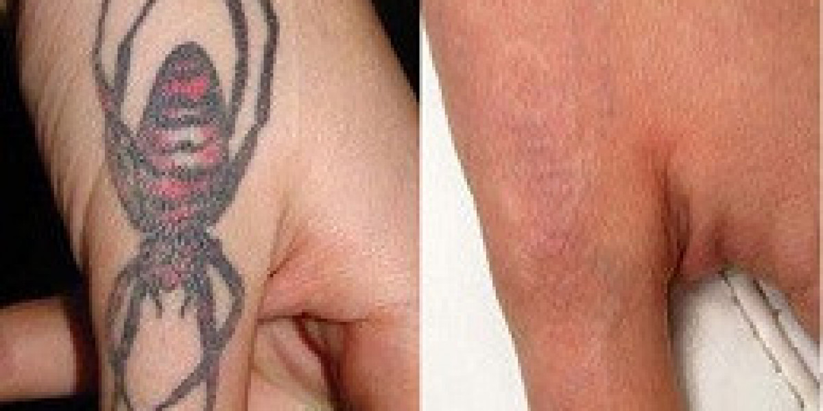 Celebrities Who Have Had Laser Tattoo Removal