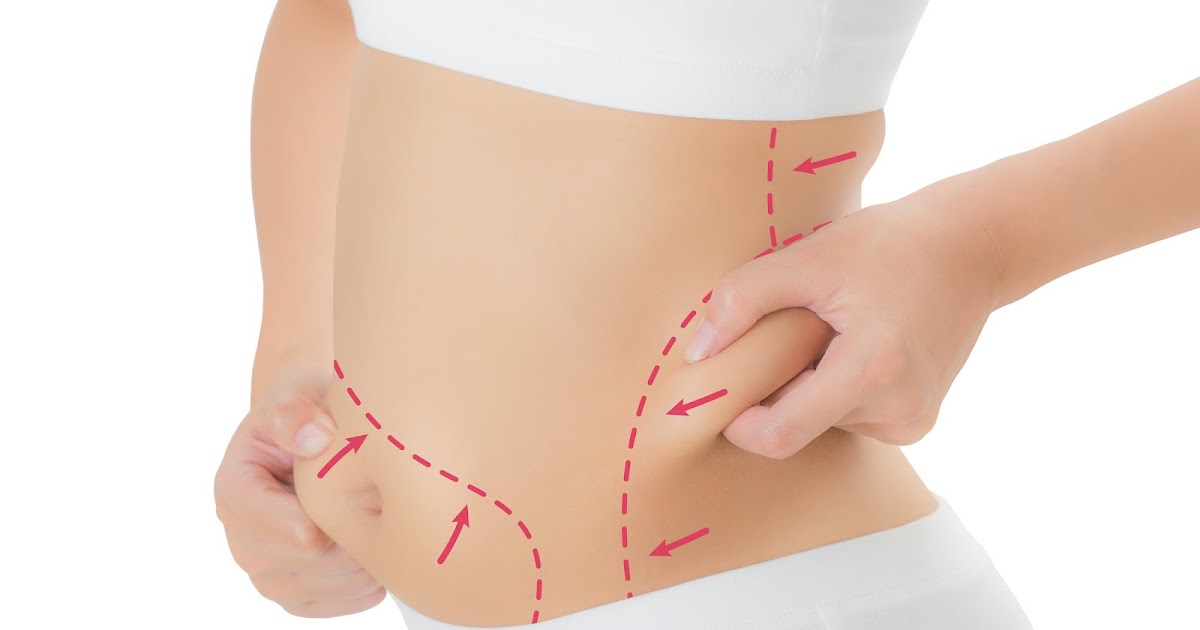 The Benefits of Liposuction: A Guide to Meeting Expectations