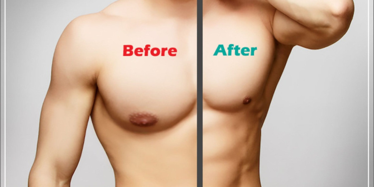 Expert Gynaecomastia Surgery in Ludhiana: Dr. Vikas Gawri's Premier Clinic