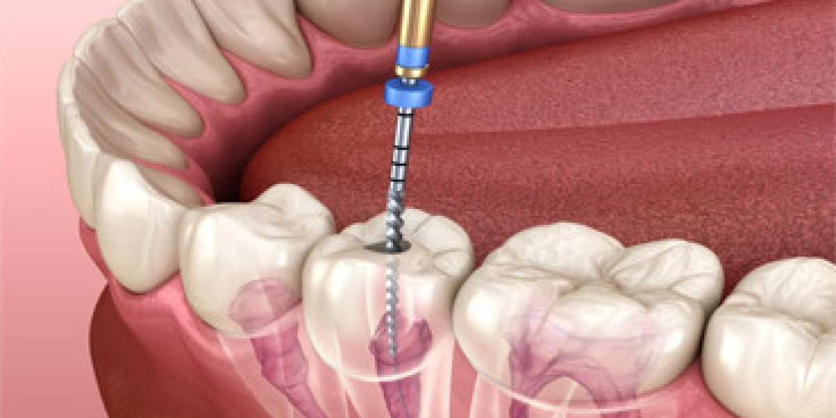 Common Myths About Root Canal Treatment Debunked in Dubai