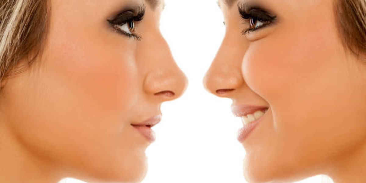 "Excellence Redefined: Rhinoplasty Surgery in Dubai"