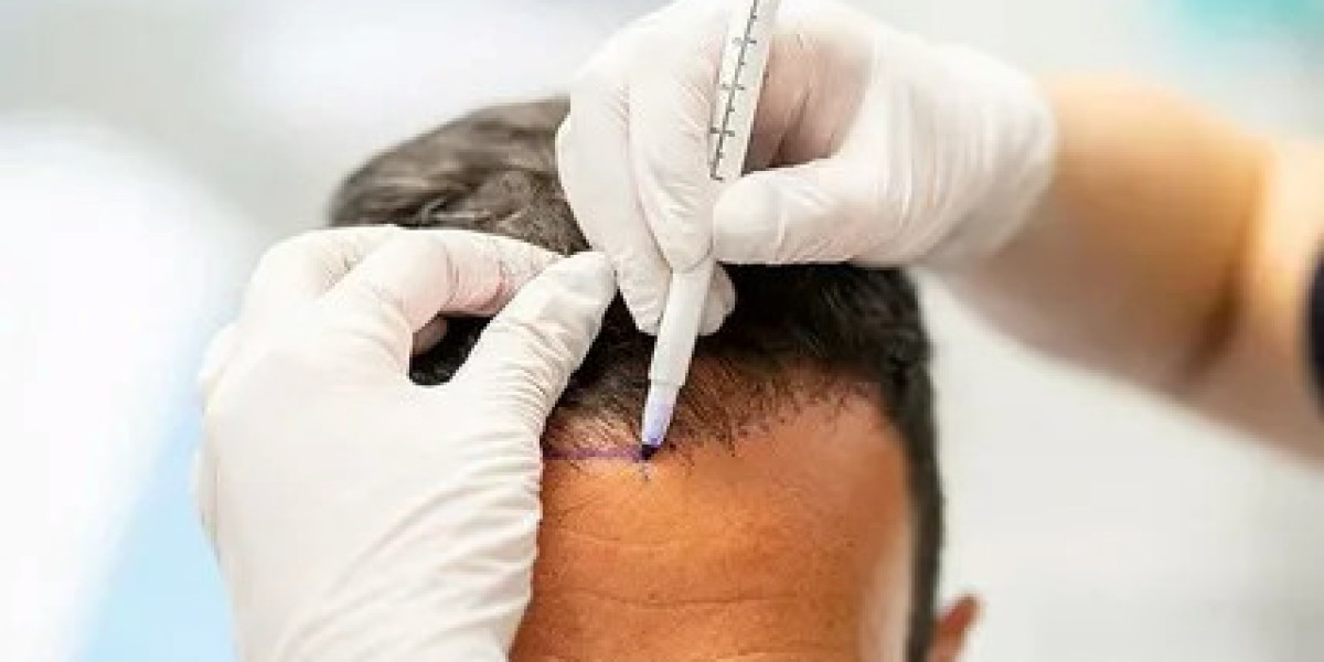 The Science Behind Hair Transplantation in Abu Dhabi