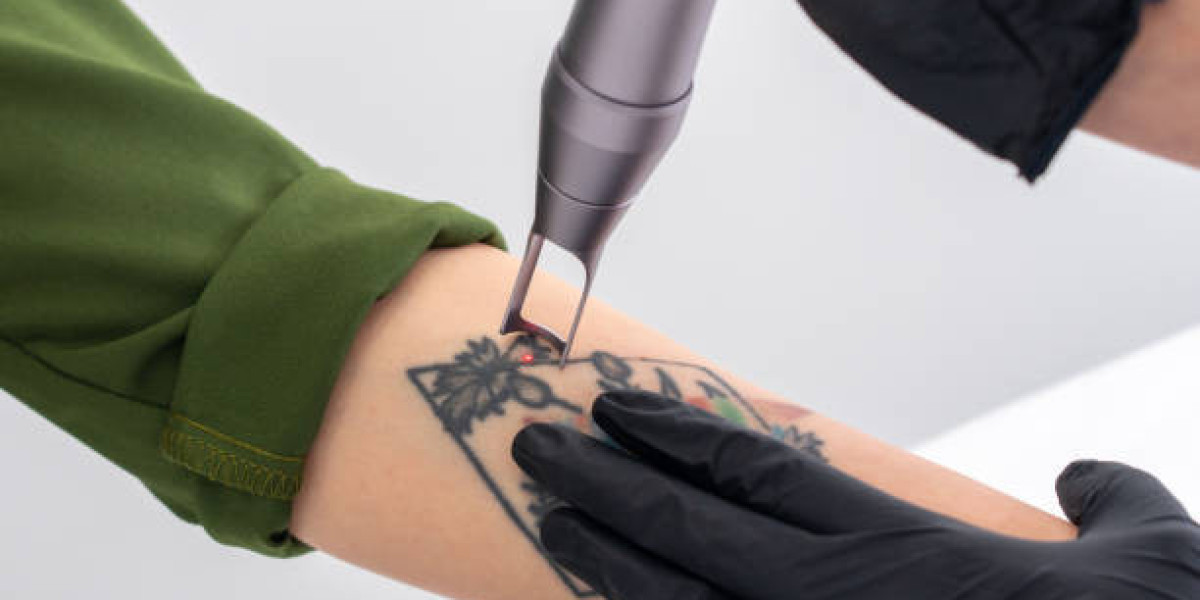 The Best Laser Tattoo Removal Solutions in Riyadh