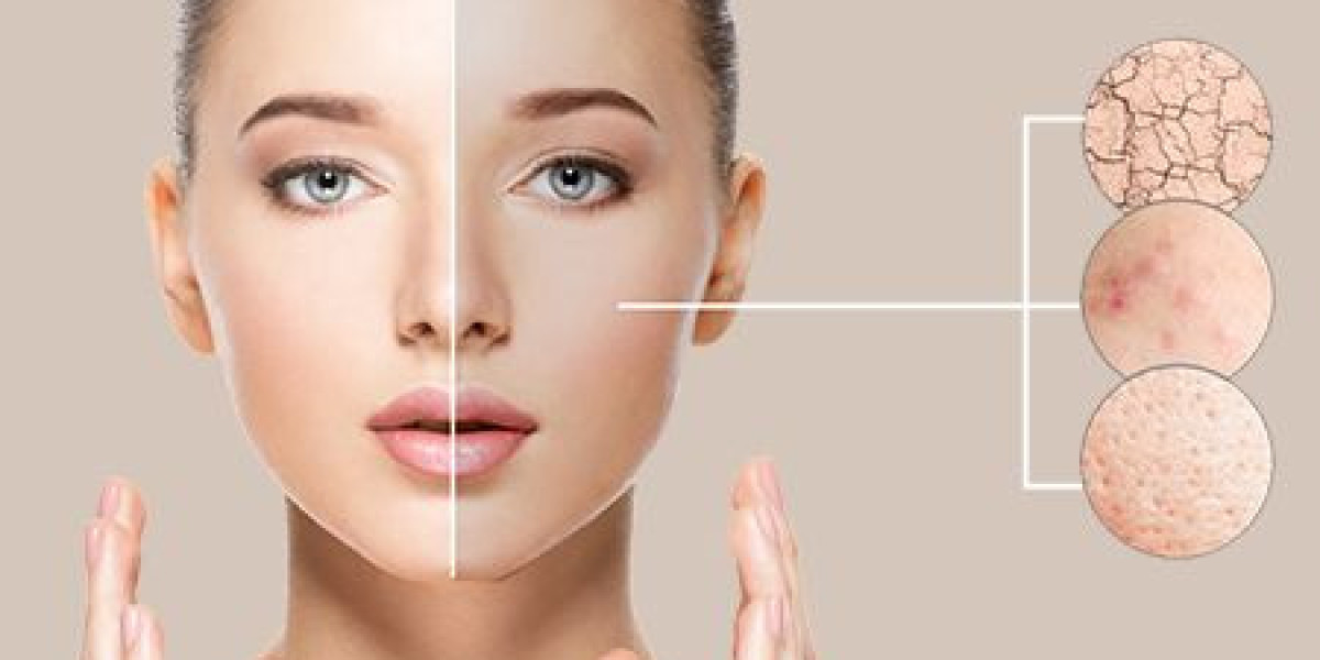 Erase Acne with Professional Laser Treatments in Riyadh