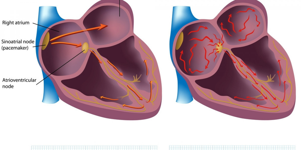 Atrial Fibrillation Diagnosis Market: Innovations and Forecast for 2024-2032