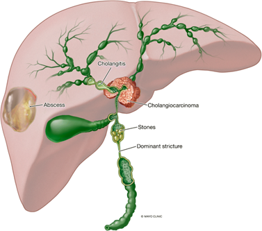 Living with PSC: A Patient’s Journey With A Rare Liver Disease: drneerav — LiveJournal