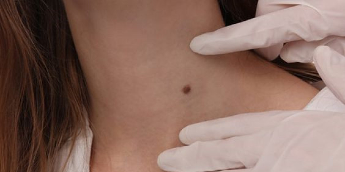 The Benefits of Skin Tag Removal Treatment: What to Expect