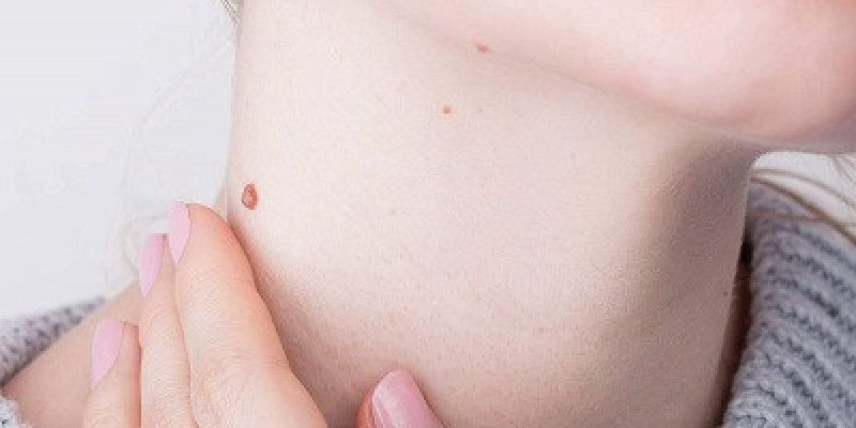 How Long Does It Take for Mole Removal?