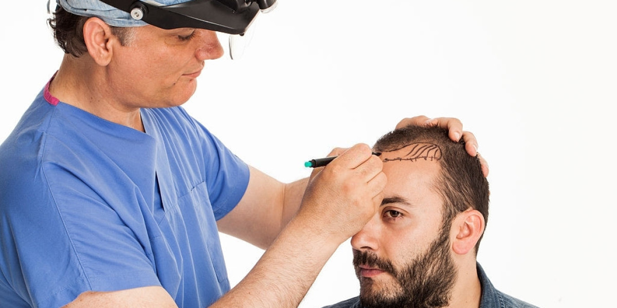 Hair Transplants for Men: Why More Men Are Choosing This Solution