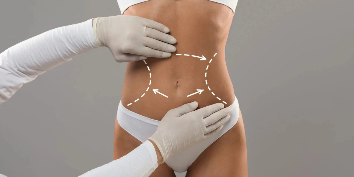 Understanding the Benefits and Process of Liposuction in Islamabad