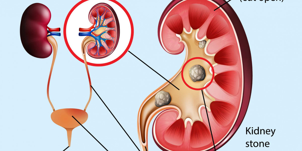 10 Ways To Prevent Kidney Stones - Dr Abhijit Gokhale