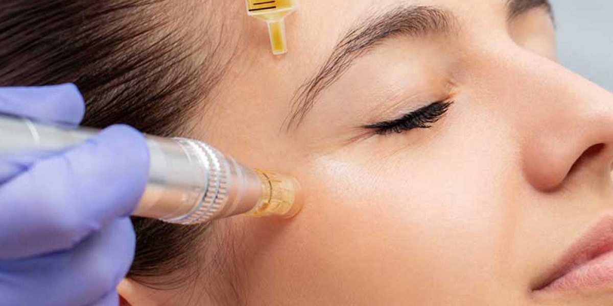 Before and After: Microneedling with PRP Therapy in Islamabad