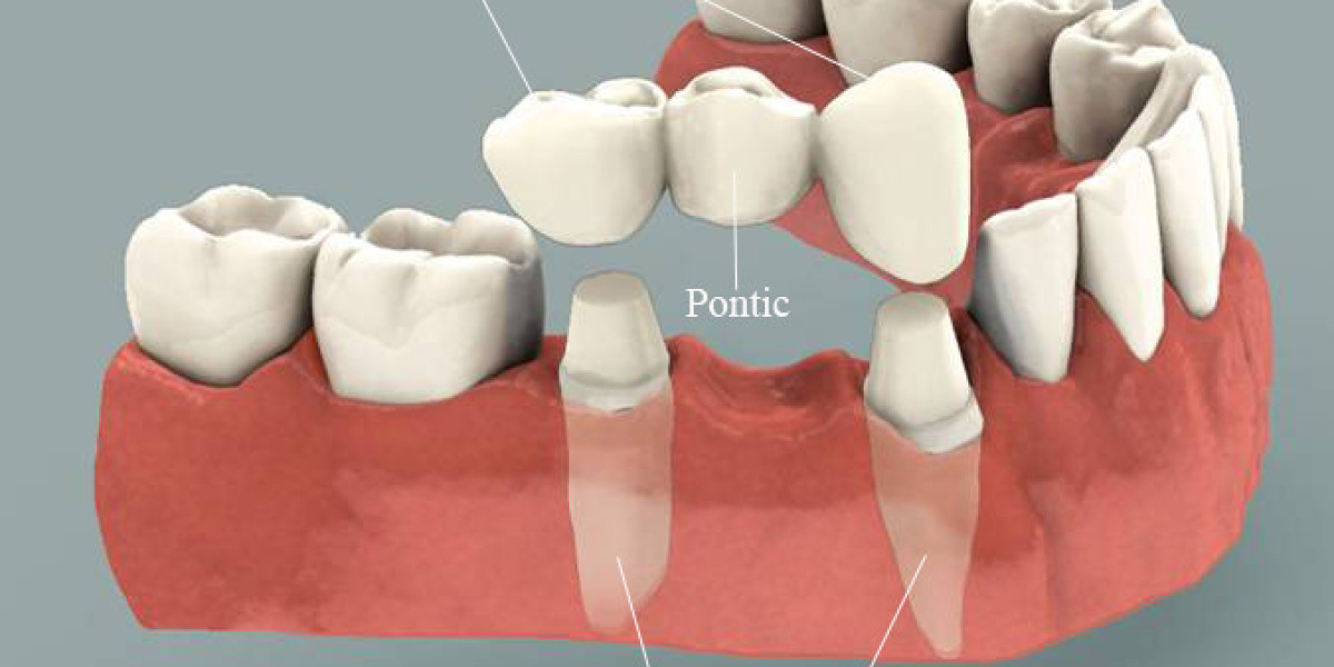 What is Porcelain Dental Bridge?