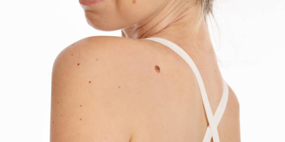 Benign Mole Removal Treatment in Riyadh: What to Expect