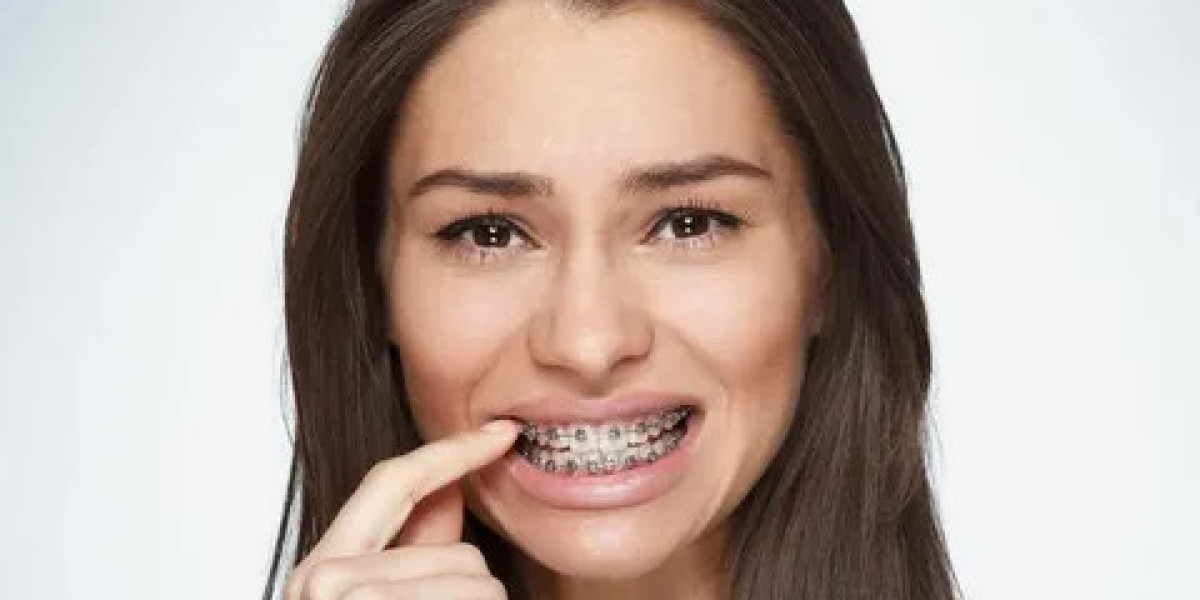 Latest Trends in Dental Braces in Islamabad for 2025