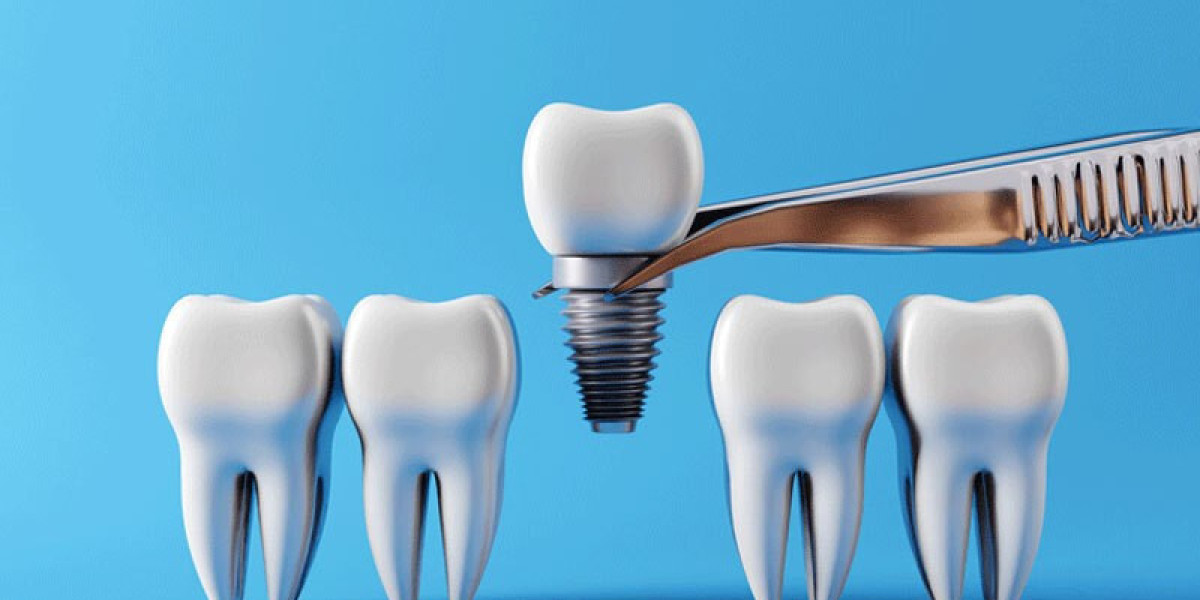 Dental Implants: A Permanent Fix for Tooth Loss