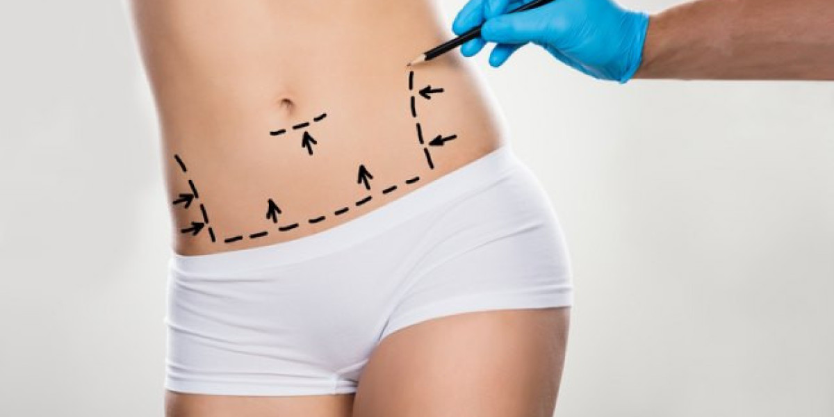 Target Unwanted Fat with Precision Liposuction in Riyadh